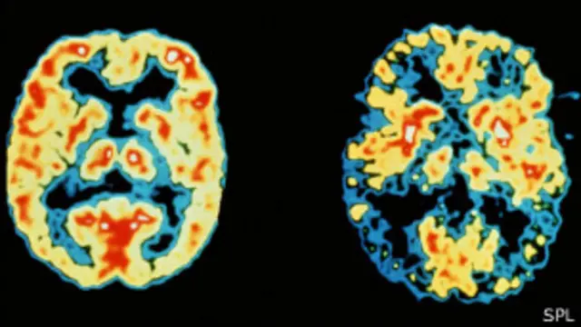 El cerebro de un paciente de alzheimer (derecha) se modifica, debido a la reducción de sus funciones y a un menor flujo de sangre.