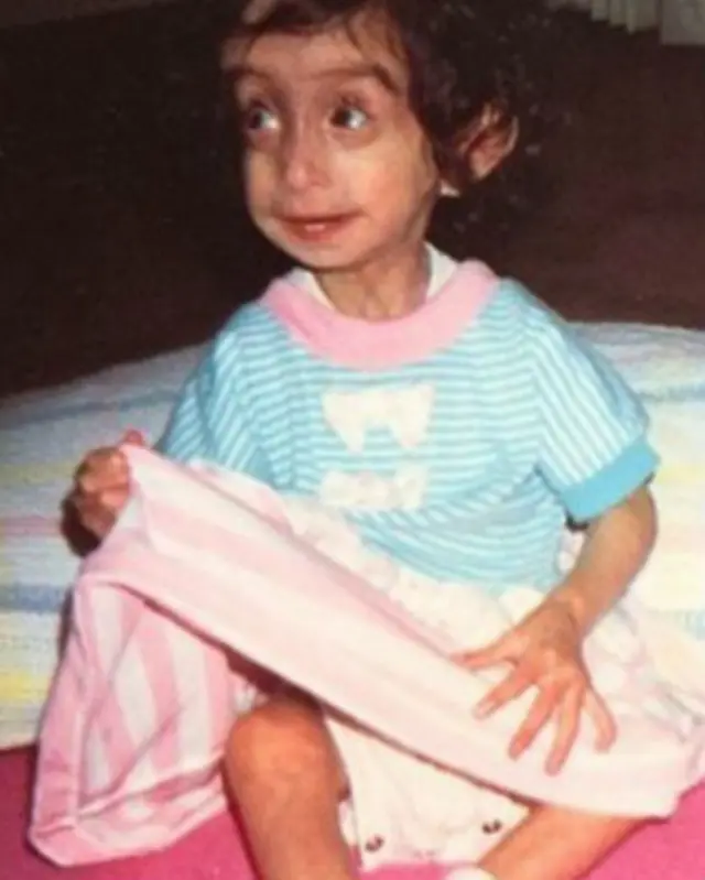 Cuando nació pesaba 1,2 kilos y los médicos dijeron a sus padres que no sabían cuánto viviría y que, en cualquier caso, tendrían que ciudar de ella por el resto de su vida.