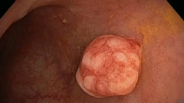 نمو لزوائد في المستقيم من الممكن أن تتحول إلى ورم سرطاني