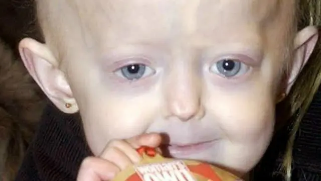 progeria