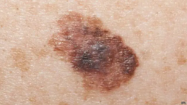 චර්ම පිළිකාවක් 