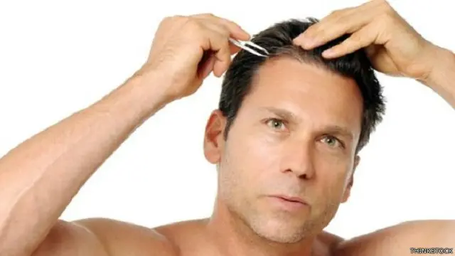 يصاب الرجال بنمط محدد من الصلع بحلول سن الخمسين، لكن العلماء غير واثقين إن كانت الدراسة تسهم في تطوير علاج لهذه الحالة.