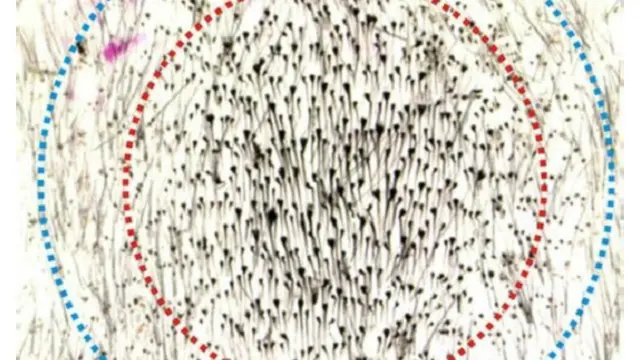 لم يؤد النتف قليل الكثافة إلى إعادة نمو أي شعر، في حين كان نمو الشعر أكبر نتيجة للنتف متوسط الكثافة. 