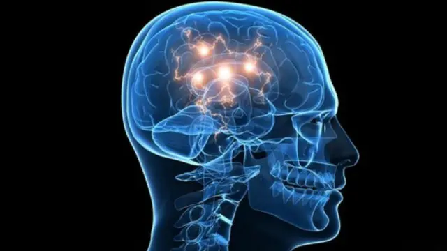 Maradhi ya Alzheimer