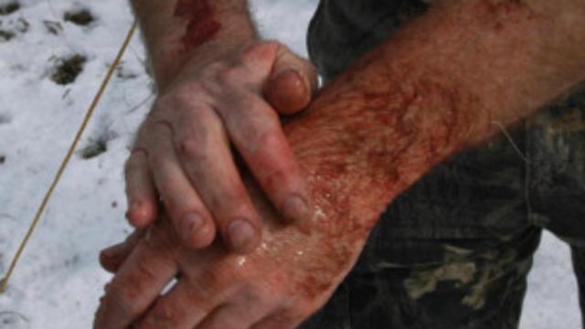 La OMS recomienda lavar la herida conciezudamente e ir al médico con urgencia ante la menor mordedura.