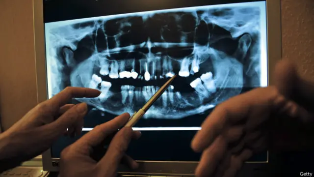 Зубні імпланти