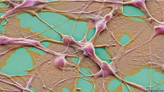 Tumor jenis teratoma memiliki jaringan yang kompleks.