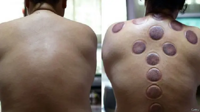 هناك طرق عدة للعلاج بالطب البديل منها الصفعه وتمديد الجسم 