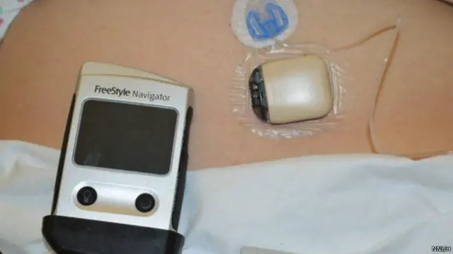 بنكرياس صناعي 