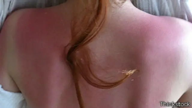 Hay que evitar a toda costa las quemaduras de sol, según los expertos.