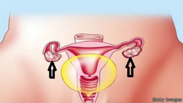 دستگاه تولید مثل زن (تخمدان‌ها با فلش مشخص شده‌اند)