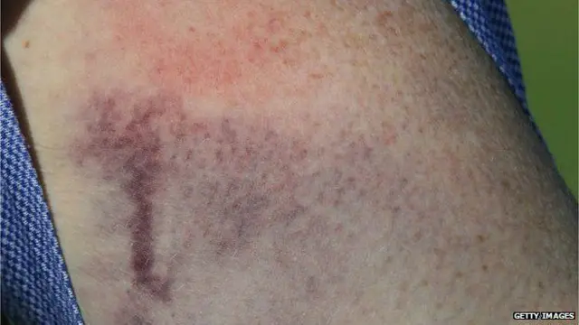 Hematoma