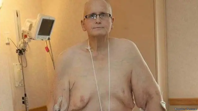 Paul Mason perdeu 285kg e fez cirurgia para remover excesso de pele