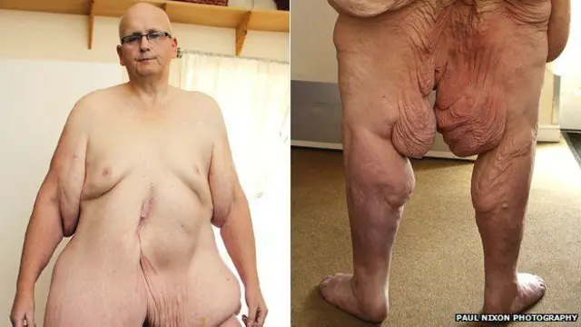 Paul Mason antes da cirurgia