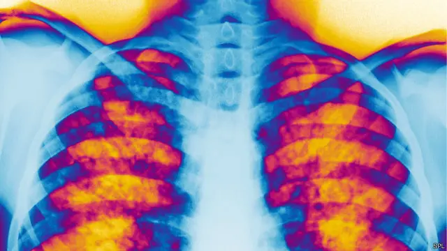يؤدي المرض إلى أضرار بالغة بالرئتين.