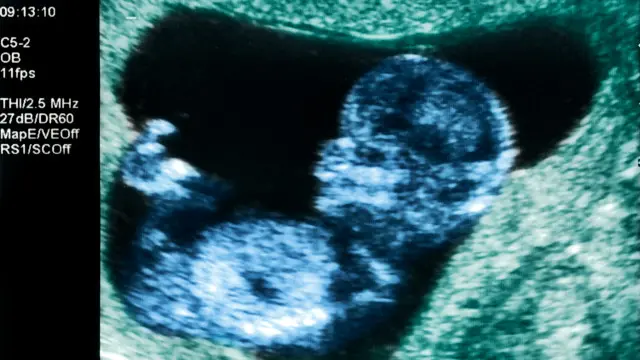 مسح بالموجات فوق الصوتية لسيدة حامل