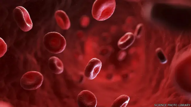 La anemia por deficiencia de hierro hace que el cuerpo tenga menos glóbulos rojos de los necesarios.