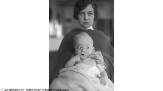 Los pacientes de Harvey Cushing