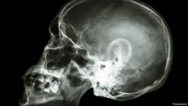 Radiografía del cerebro