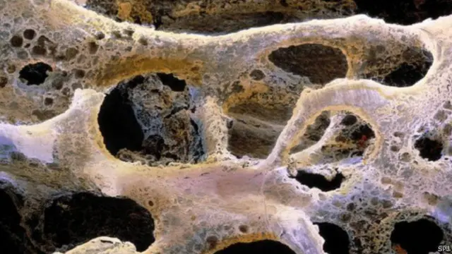 يتمكن سرطان الثدي من تغيير بنية العظام 