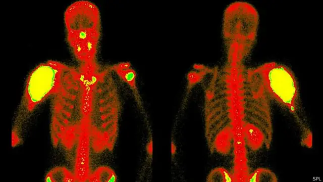 El tecnecio hace que los huesos sean visibles con rayos X.