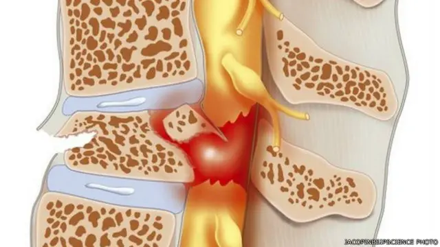 النخاع الشوكي 