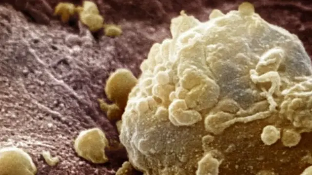 меланома під мікроскопом