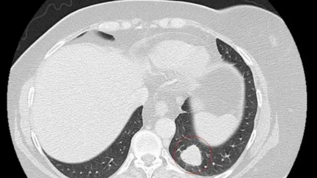 مسح يظهر السرطان الملاينيني كورم داخل دائرة حمراء