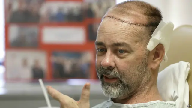 estadounidense, trasplante, triple, craneo, cuero cabelludo