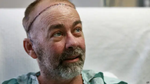 estadounidense, trasplante, triple, craneo, cuero cabelludo