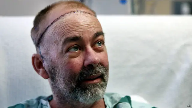 أجرى الأطباء العملية التي استغرقت 15 ساعة لرجل كان يعاني من جرح في الرأس لم يندمل بعد خضوعه لعلاج سرطان نادر