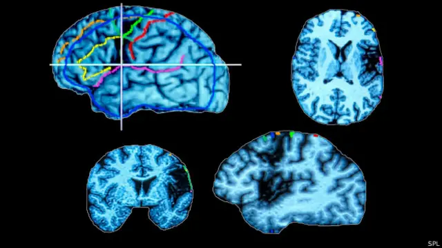 Tomografía cerebral