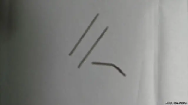 ऑपरेशन करके निकाली गई तीन सूइयां