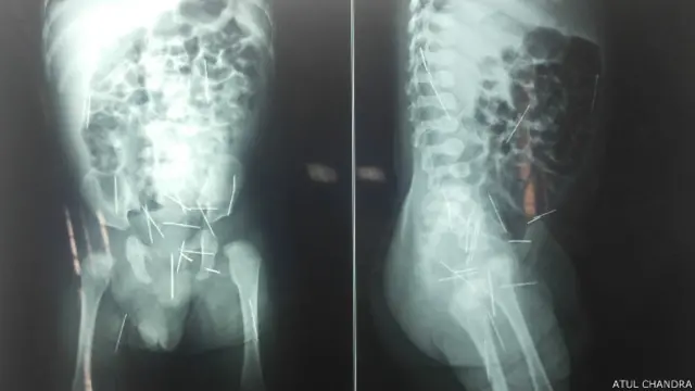 चार माह के बच्चे के शरीर में सूइयां 