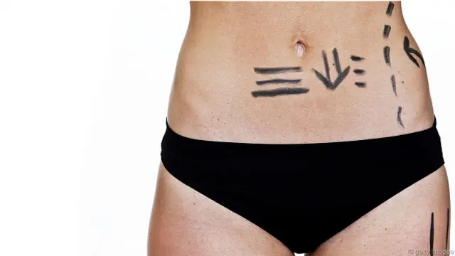 Разметка перед пластической операцией