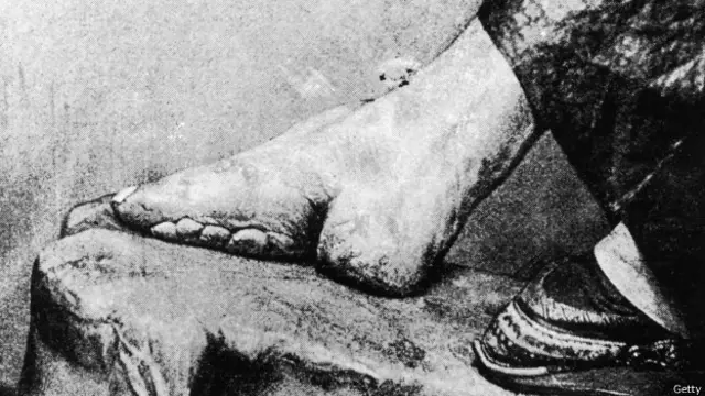 Un pie deforme debido a la costumbre china de vendar los pies