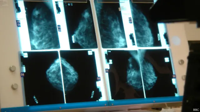 أوضحت الدراسة إلى أن هرمون البروجسترون قد يساعد في إبطاء نمو بعض الأورام السرطانية