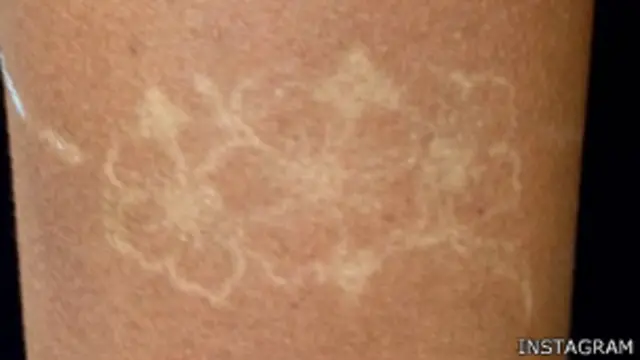 Cuando el melanoma se extiende por el cuerpo, las posibilidades de morir son significativas.