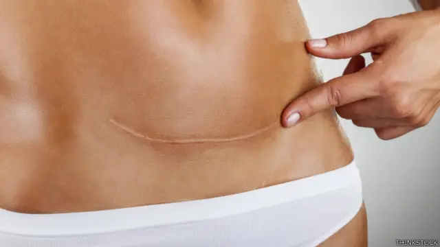 Lo normal sería un 10% o 15% de partos por cesárea, pero en países como Brasil superan el 50%.