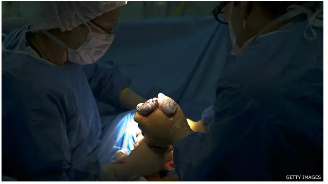 د زیږون د جراحي عملیاتو مخالفین استدلال کوي چې په کنترول شویو شرایطو کې په طبیعي توګه زیږول زړو میندو او ګڼو زیږولو لپاره ګټه لري.