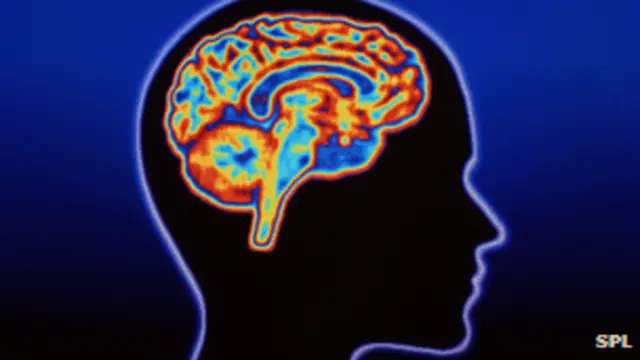 La enfermedad de Huntington es un desorden genético que afecta al cerebro y que no tiene cura. 