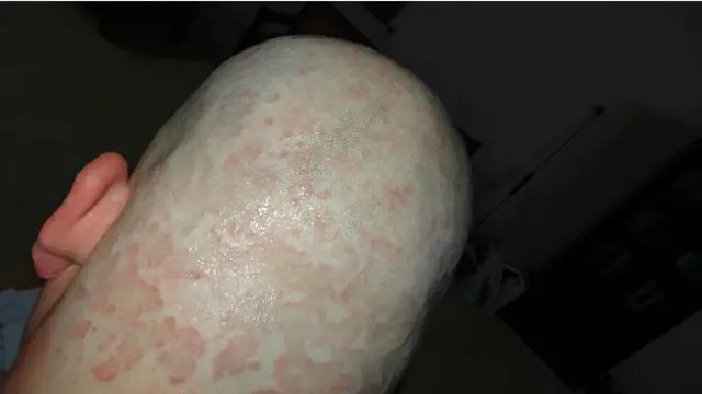 Rambut di kepala Taim dicukur habis oleh teman-temannya.