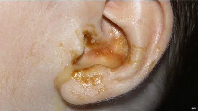 کان کے میل سے ہر پانچ میں سے چار بچے 10 سال کی عمر تک متاثر ہوتے ہیں