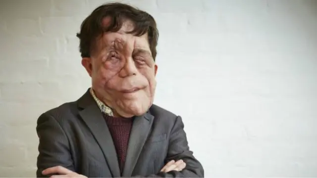 "La desfiguración apenas está representada en nuestra cultura mediática", dice Adam Pearson.
