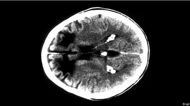 Рентгеновский снимок черепа
