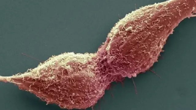 يعد سرطان البروستاتا من أكثر أمراض السرطان التي تحدث وفيات بين الرجال. 