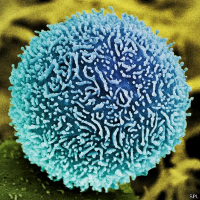 سلول سرطانی پانکراس