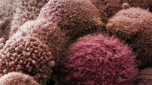 Только 3% больных раком поджелудочной железы живут более пяти лет после постановки диагноза