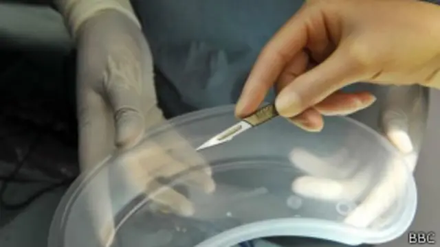 Instrumentos para un trasplante de riñón