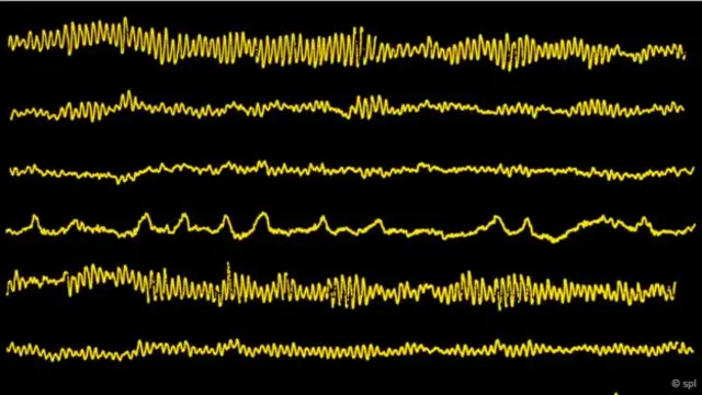 對阿爾法腦電波的抑制可能有助於解釋該病症(圖片來源:SP)